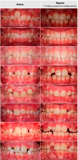 Invisalign First - Perguntas frequentes - Hiroce Ortodontia e Estética